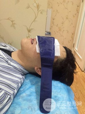 深圳南西子袁新平医生给我做的祛眼袋手术，真实案例以及前后对比照片分享