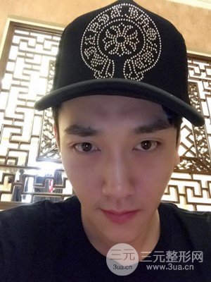 深圳南西子袁新平医生给我做的祛眼袋手术，真实案例以及前后对比照片分享