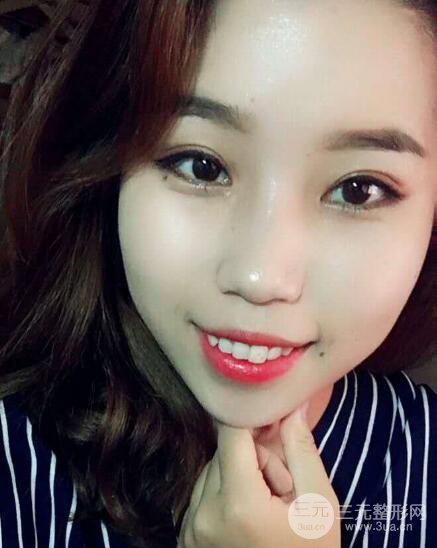 切开双眼皮无疤痕增生果图案例