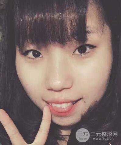 切开双眼皮无疤痕增生果图案例