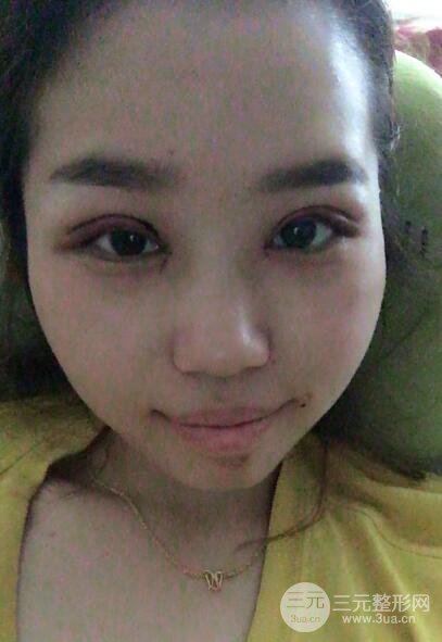 切开双眼皮无疤痕增生果图案例