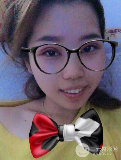 切开双眼皮无疤痕增生果图案例