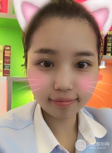 切开双眼皮无疤痕增生果图案例