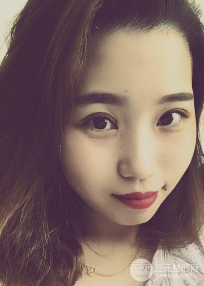 切开双眼皮无疤痕增生果图案例