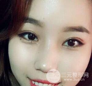 切开双眼皮无疤痕增生果图案例