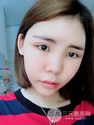 自体脂肪填充全脸真实案例——济南爱容张庆国医生做的