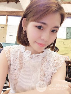 自体脂肪填充全脸真实案例——济南爱容张庆国医生做的