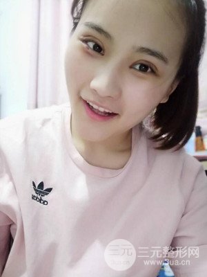 双眼皮多项整形整形案例以及前后对比图分享——济南爱容路传燕医生做的~