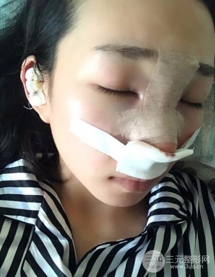 隆鼻整形价格和真人案例