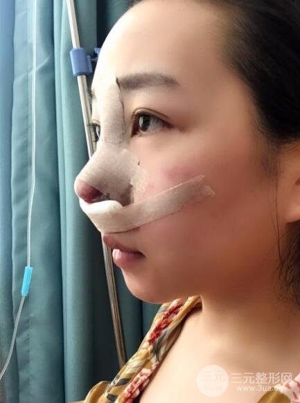 隆鼻整形价格和真人案例