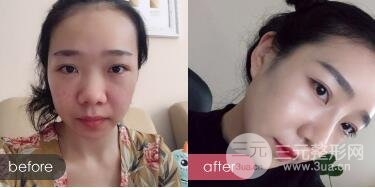 隆鼻整形价格和真人案例