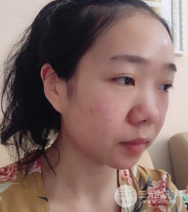 隆鼻整形价格和真人案例