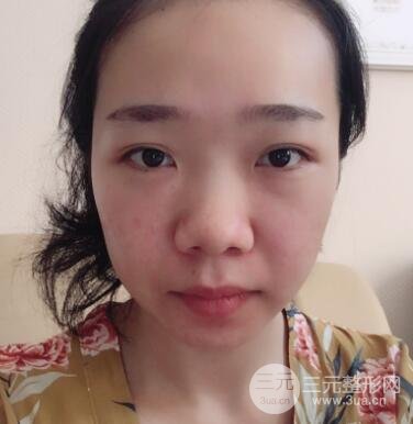 隆鼻整形价格和真人案例