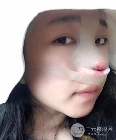 隆鼻整形价格和真人案例