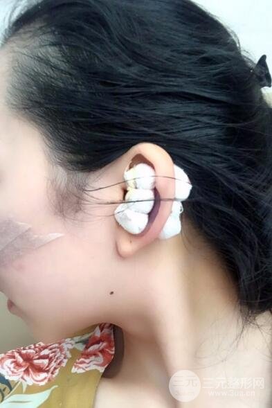 隆鼻整形价格和真人案例