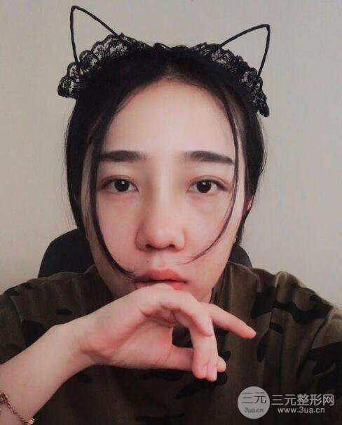 隆鼻整形价格和真人案例