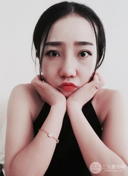 隆鼻整形价格和真人案例