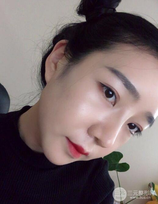 隆鼻整形价格和真人案例