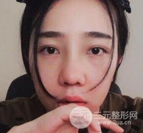 隆鼻整形价格和真人案例