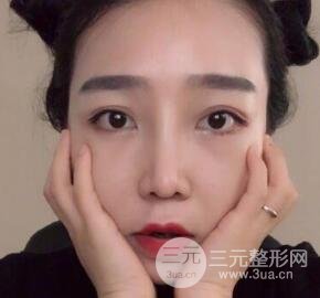 隆鼻整形价格和真人案例