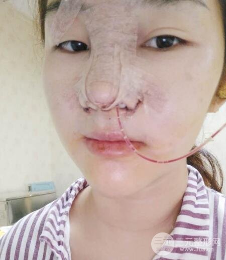 蒜头鼻整形价格和对比照片案例