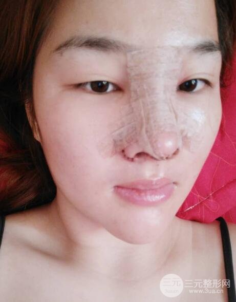 蒜头鼻整形价格和对比照片案例