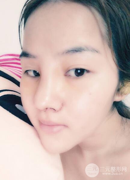 蒜头鼻整形价格和对比照片案例