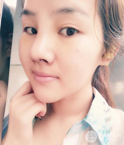 蒜头鼻整形价格和对比照片案例