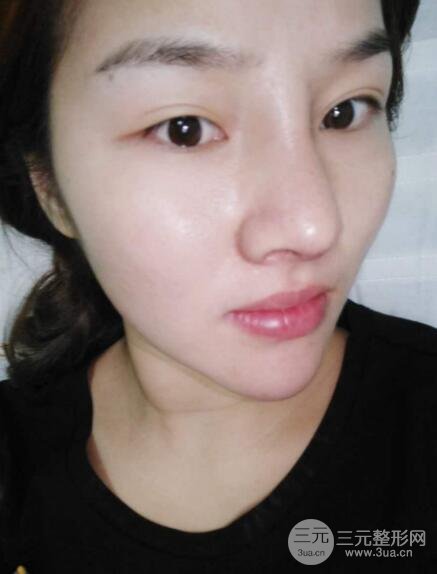 蒜头鼻整形价格和对比照片案例