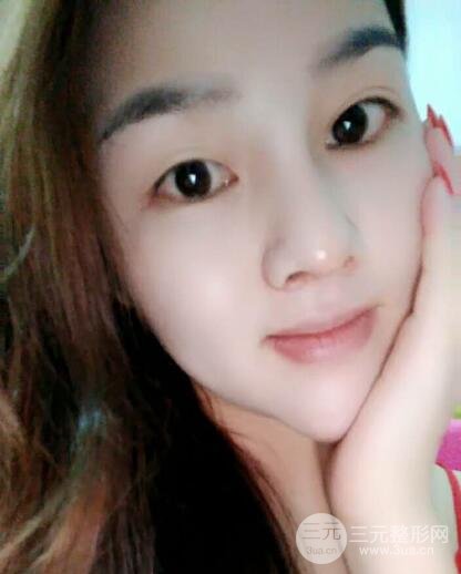 蒜头鼻整形价格和对比照片案例