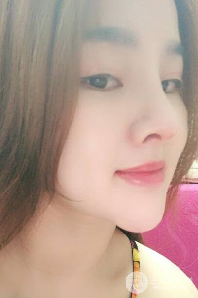 蒜头鼻整形价格和对比照片案例