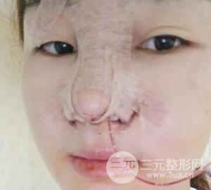 蒜头鼻整形价格和对比照片案例