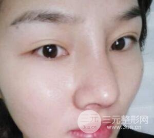 蒜头鼻整形价格和对比照片案例
