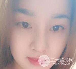 蒜头鼻整形价格和对比照片案例