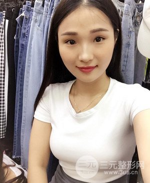 济南海峡赵广生自体脂肪隆胸真实案例附上前后对比图