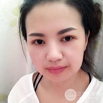 济南海峡谢燕燕做的双眼皮多项整形整形手术，分享一下前后对比图