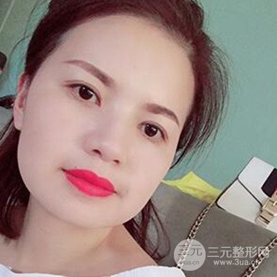 济南海峡谢燕燕做的双眼皮多项整形整形手术，分享一下前后对比图