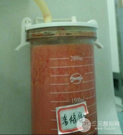 大腿环吸抽脂价格和图片案例