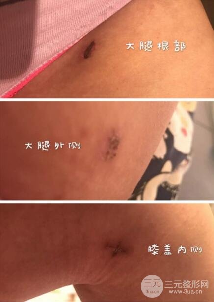 大腿环吸抽脂价格和图片案例