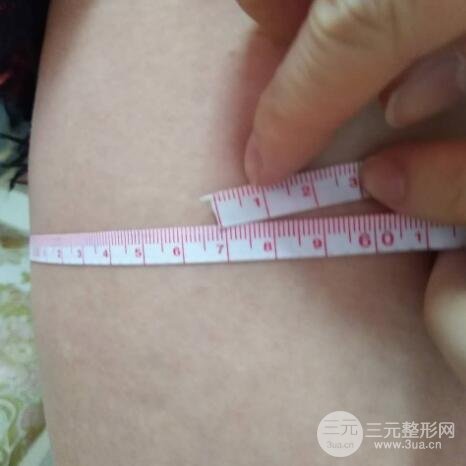 大腿环吸抽脂价格和图片案例