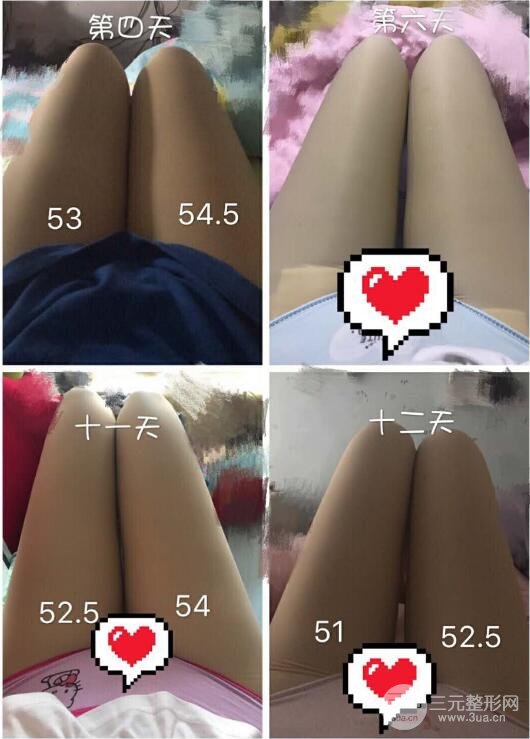 大腿环吸抽脂价格和图片案例
