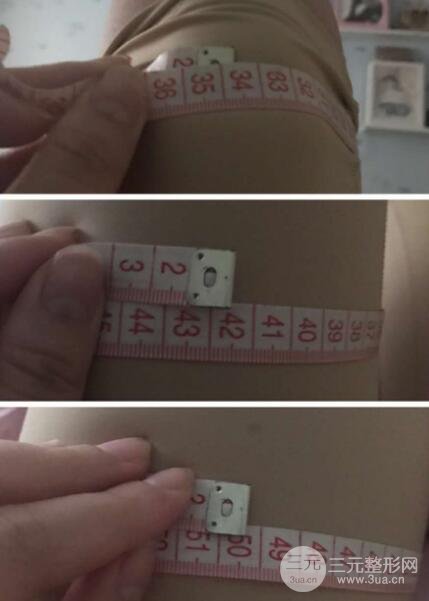 大腿环吸抽脂价格和图片案例