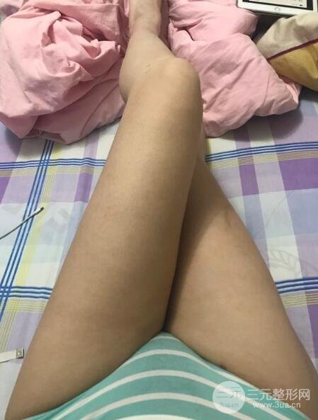 大腿环吸抽脂价格和图片案例