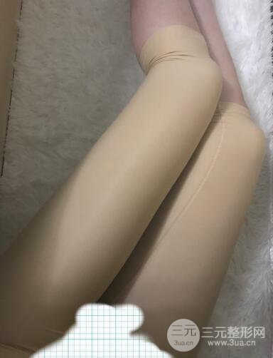 大腿环吸抽脂价格和图片案例