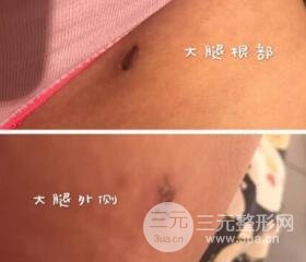 大腿环吸抽脂价格和图片案例