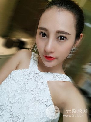 隆鼻失败修复手术真实案例以及前后对比图——青海康华冯相周医生做的