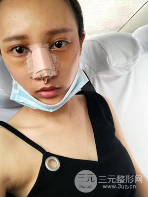 隆鼻失败修复手术真实案例以及前后对比图——青海康华冯相周医生做的