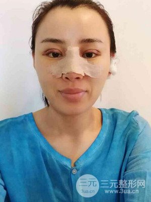 青海康华马晶医生给我做的硅胶假体隆鼻+双眼皮手术，分享一下前后对比图