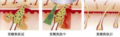 草莓鼻子怎么去掉?果酸换肤是有的方法