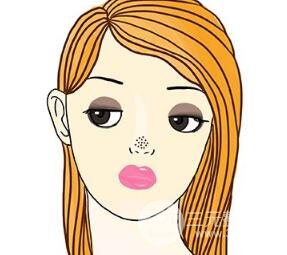 草莓鼻子怎么去掉?果酸换肤是有的方法
